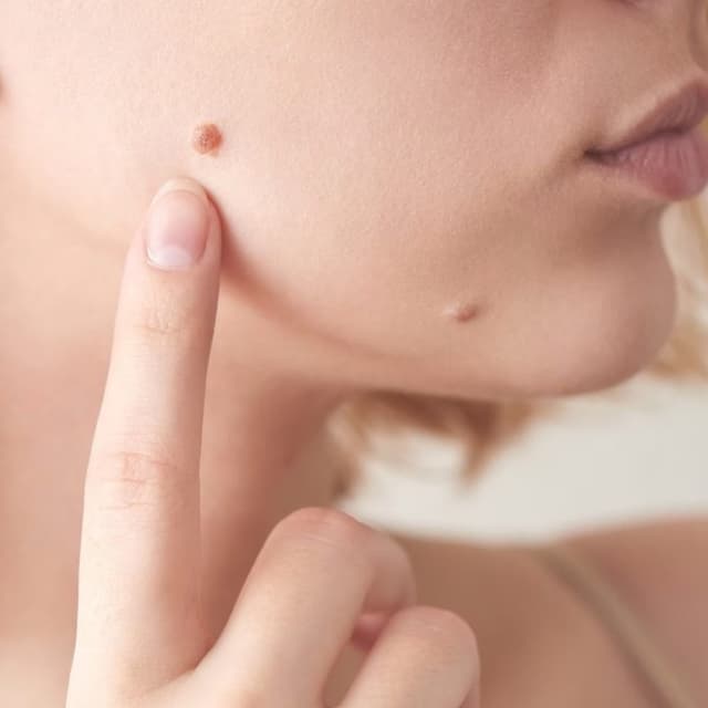 Mole & wart removal